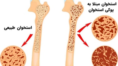سن ابتلا به پوکی استخوان در زنان و مردان چقدر است؟