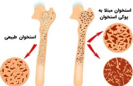 سن ابتلا به پوکی استخوان در زنان و مردان چقدر است؟